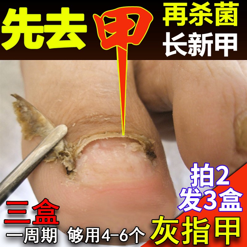 【不满意我买单】去除灰指甲特效中草药增厚灰指甲脱甲液专用抑菌液软甲膏甲沟炎灰指甲特效液